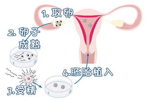 人流手术